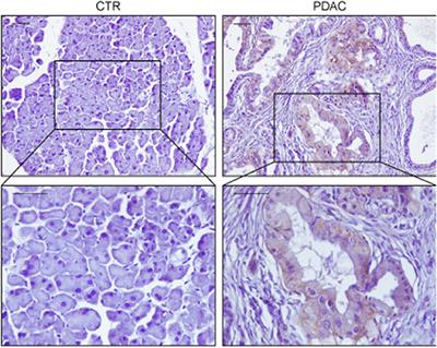 KRAS-Driven Metabolic Rewiring Reveals Novel Actionable Targets in Cancer